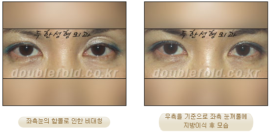 두한성형외과 쌍커풀 재수술 - 짝눈 눈매교정, 가성 안검하수 교정과 뒤밑트임 관련 이미지 19