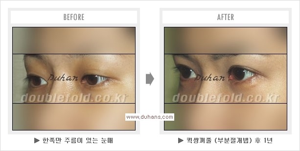 ​[두한성형외과 경쟁력 눈성형] - [퀵쌍꺼풀(부분절개법) 수술 관련 자주하는 질문과 답변] 관련 이미지 9