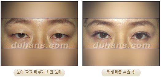 [Duhan Plastic Surgery Double Eyelid Surgery] - [Types of Double Eyelid Surgery] image 22