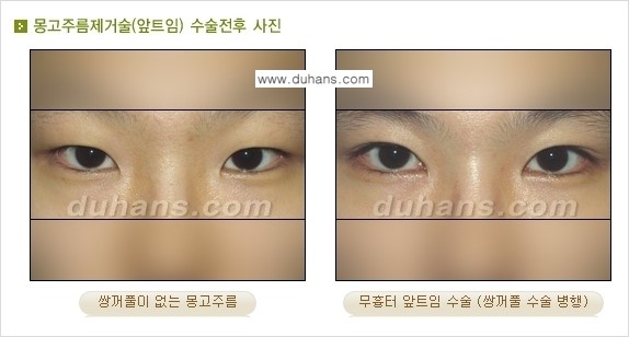 [두한성형외과 NO.1 눈성형] - [몽고주름 제거(앞트임 수술) 2.] 관련 이미지 9