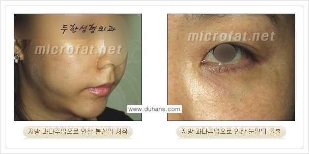 ​[두한성형외과 경쟁력 미세지방이식] - [타병원에서의 미세지방이식 부작용 종류와 문제점 안내] 관련 이미지 3