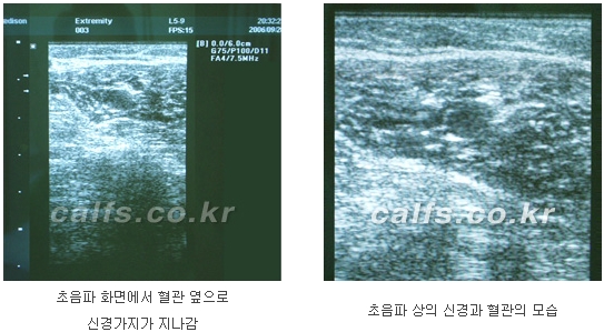 [두한성형외과 종아리퇴축술] - [NO절개! 초음파유도신경차단술] 관련 이미지 14