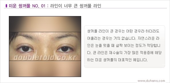 [두한성형외과 경쟁력 쌍꺼풀 재수술, 극한 눈재수술] - [Dr. 컬럼 - 재수술의 목표] 관련 이미지 4