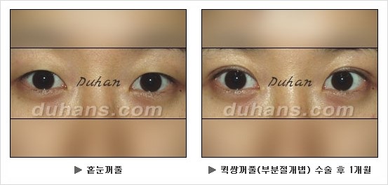 [두한성형외과 경쟁력 눈성형] - [눈성형 방법에 대한 흔한 질문과 답변 안내] 관련 이미지 5