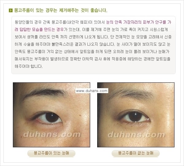 ​[두한성형외과 경쟁력 눈성형] - [자연스럽고 아름다운 쌍꺼풀의 기준] 관련 이미지 5