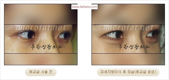 ​﻿[두한성형외과 경쟁력 지방이식] - [눈밑 애교살 시술을 위한 미세지방이식] 관련 이미지 28