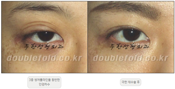 [Double Eyelid Surgery, Duhan Plastic Surgery] - [Extreme Revision Eye Surgery to Correct a Damaged Line] image 21