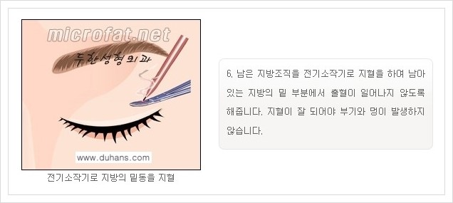 [두한성형외과 경쟁력 지방제거] - [눈밑지방제거, 눈위(윗눈꺼풀)지방제거 안내] 관련 이미지 10