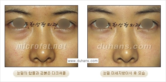[두한성형외과 FOCUS 눈밑성형] - [다크써클의 치료방법 -  콜펫(Col-fat) 눈밑 미세지방이식 ⑤] 관련 이미지 6