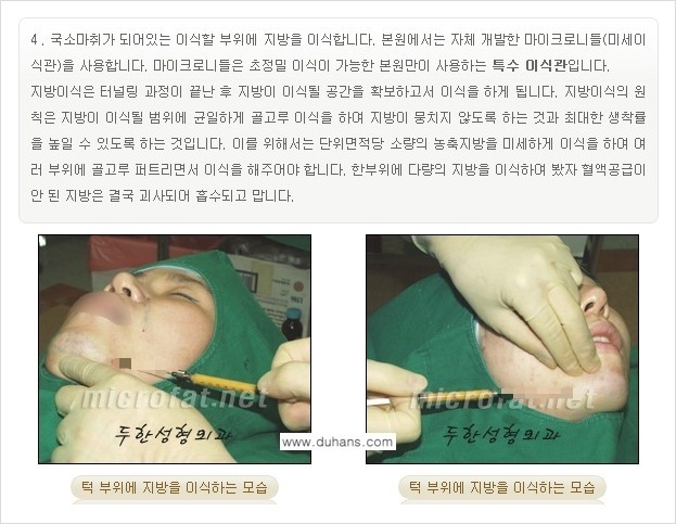 [두한성형외과 경쟁력 미세지방이식] - [얼굴 윤곽 무턱교정 안내 ②] 관련 이미지 5