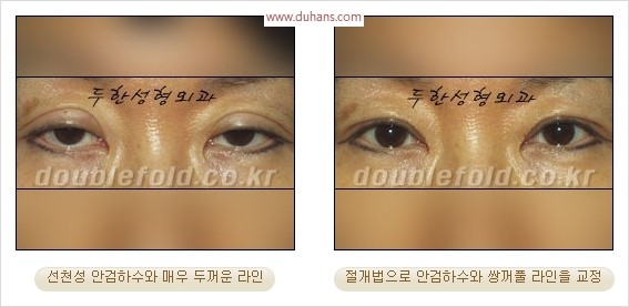 [두한성형외과 경쟁력 눈성형] - [극한 재수술, 함몰된 눈꺼풀 라인교정, 안검하수(졸리운 눈매)] 관련 이미지 100
