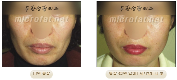 [두한성형외과 미세지방이식] - [자가지방이식] 관련 이미지 13