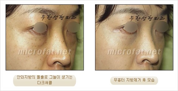 [두한성형외과 쌍커풀수술] - [눈성형 방법에 대한 자주하는 질문과 답변] 관련 이미지 157
