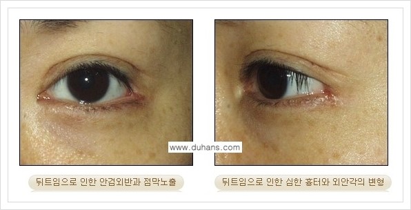 [두한성형외과 경쟁력 있는 쌍꺼풀 재수술] - [뒤트임 수술] 관련 이미지 8