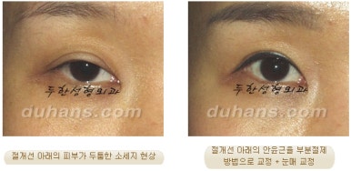 Best Place for Revision Eyelid Surgery, Duhan Plastic Surgery - Lowering Double Eyelid Line image 24