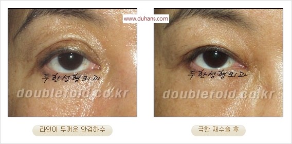 [두한성형외과 경쟁력 쌍꺼풀 재수술] - [두꺼운 라인을 교정하는 극한 재수술(Extreme Rroperation)] 관련 이미지 9