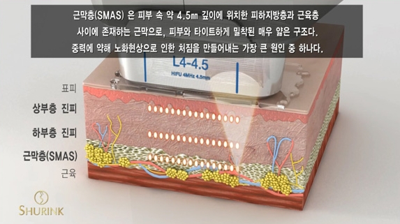 두한성형외과 주름개선 - 주름 HIFU 리프팅 관련 이미지 8