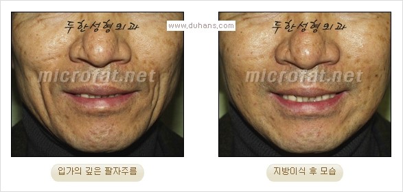 [두한성형외과 경쟁력 주름성형] - [입가주름과 코옆 팔자주름제거 지방이식 시술의 효과] 관련 이미지 9
