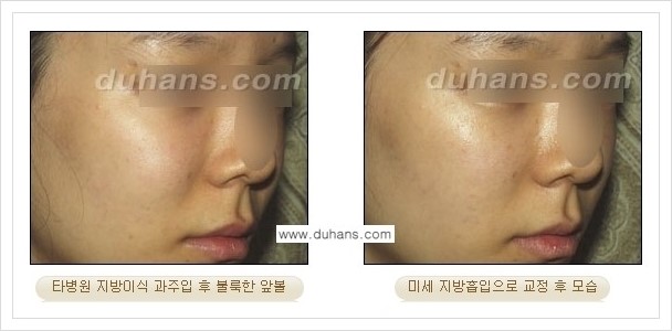[두한성형외과 경쟁력 얼굴 미세지방이식] - [타병원에서 지방이식 후 굴곡과 과주입 교정 안내] 관련 이미지 8