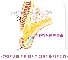 [두한성형외과 쌍꺼풀재수술] - [쌍꺼풀재수술성공요건, 쌍꺼풀재수술과정] 관련 이미지 7