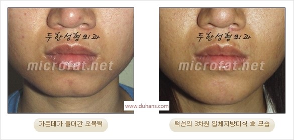 [두한성형외과 경쟁력 안면윤곽 성형 리더] - [완변한 V 라인! 턱 미세지방이식, 볼살 미세지방이식, 사각턱 보톡스 안내] 관련 이미지 12