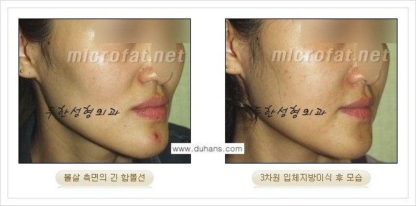 [두한성형외과 경쟁력 윤곽성형] - [볼, 볼살 지방이식] 관련 이미지 20