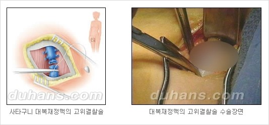 [두한성형외과 경쟁력 정맥류 치료] - [정맥류와 정맥확장증 치료] 관련 이미지 8
