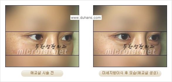 [두한성형외과 무한 경쟁력 눈밑성형] - [애교살 시술 1.] 관련 이미지 8