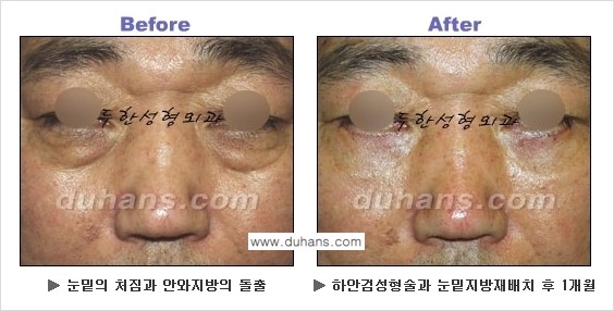 [두한성형외과의 상큼하고 환한 젊은 눈매완성] - [하안검 성형술 ①] 관련 이미지 22