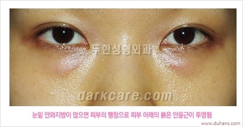 [두한성형외과 경쟁력 눈밑성형] - [눈밑 안와지방 돌출의 무통마취 무흉터 눈밑지방제거 안내] 관련 이미지 5