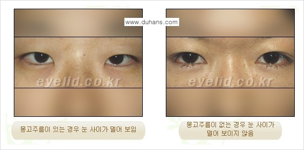 [두한성형외과 성형 FOCUS] - [앞트임 복원수술] 관련 이미지 1