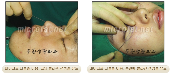 [두한성형외과 자가지방이식] - [3차원 미세지방이식] 관련 이미지 10