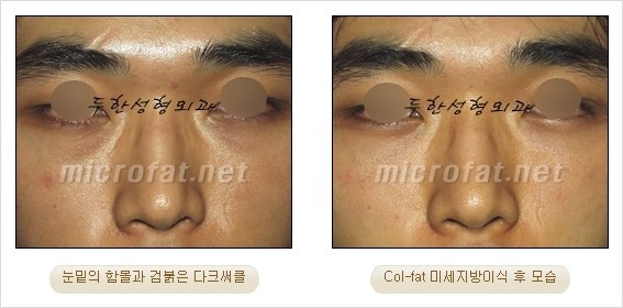 ​[두한성형외과 경쟁력 눈밑성형 리더] - [눈밑 다크써클의 증상, 원인, 종류, 치료방법 안내] 관련 이미지 46