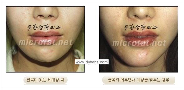 [두한성형외과 경쟁력 미세지방이식] - [부드럽고 아름다운 얼굴윤곽선 턱(하악부) 미세지방이식 안내] 관련 이미지 4