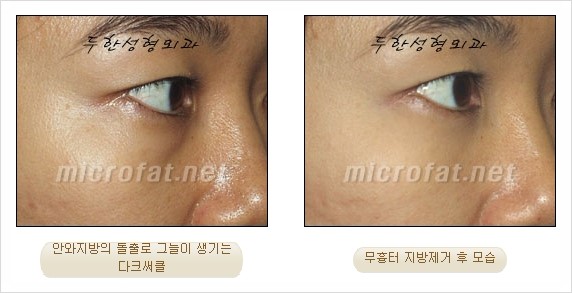 [두한성형외과 쌍커풀수술] - [눈성형 방법에 대한 자주하는 질문과 답변] 관련 이미지 187