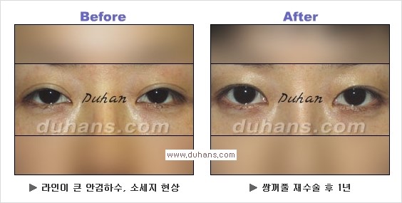 [두한성형외과 경쟁력 쌍꺼풀 재수술, 극한 눈재수술] - [과한 아웃폴드 쌍꺼풀 라인 교정 방법] 관련 이미지 4