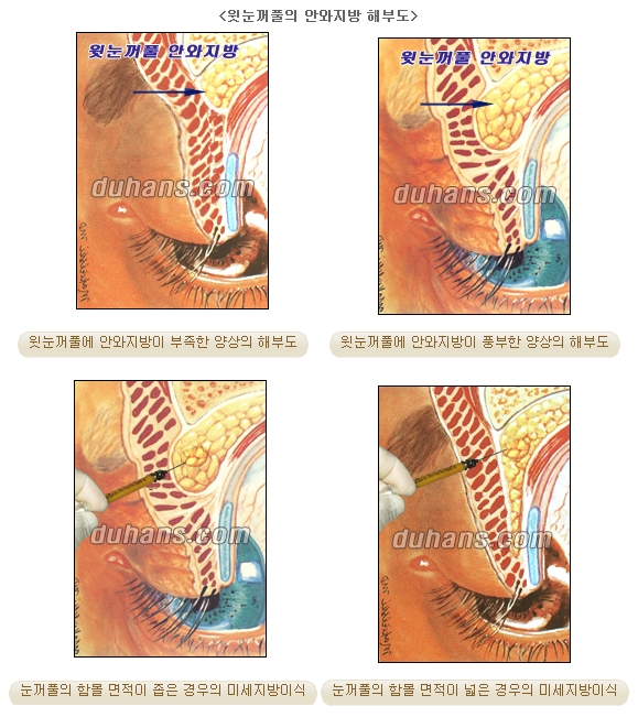 [Duhan Plastic Surgery Micro Fat Grafting] - [Upper Eyelids] image 2
