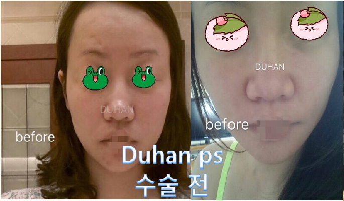 [Duhan Plastic Surgery] [Revision Double Eyelid Surgery, Uneven Eyes, Asymmetric Eyes, Uneven Double Eyelids, Increasing the Double Eyelid Line, Under-Eye Surgery, Dark Circles, Nose Revision Surgery] image 2