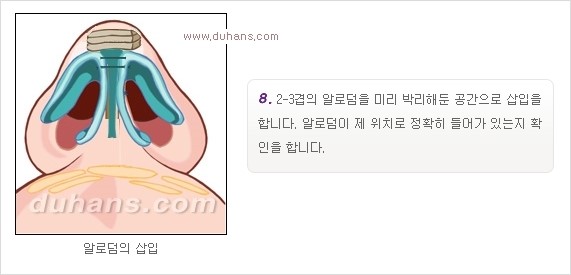 [두한성형외과 경쟁력 코성형] - [코성형을 위한 알로덤(슈어덤) 수술, 실리콘 수술 안내] 관련 이미지 11