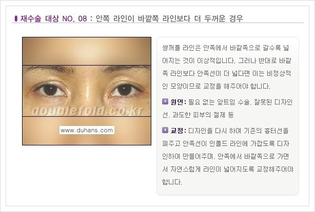 ⁠⁠[두한성형외과 경쟁력 쌍꺼풀 재수술, 극한 재수술] - [쌍꺼풀 재수술이 필요한 경우 안내] 관련 이미지 9