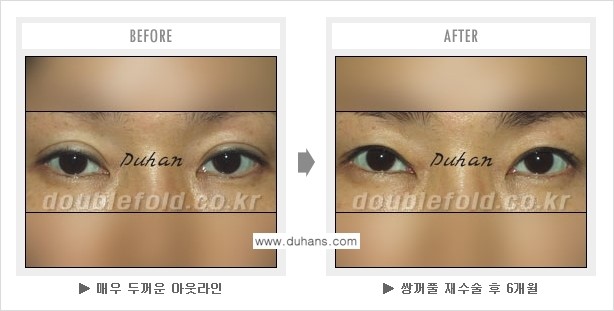 [두한성형외과 경쟁력 "극한 눈(쌍꺼풀) 재수술"] - ["극한 눈(쌍꺼풀) 재수술" 관련 질문과 답변 2.] 관련 이미지 5