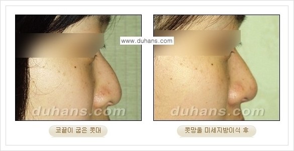 [두한성형외과 경쟁력 코성형] - [미세지방이식 코성형 안내] 관련 이미지 6