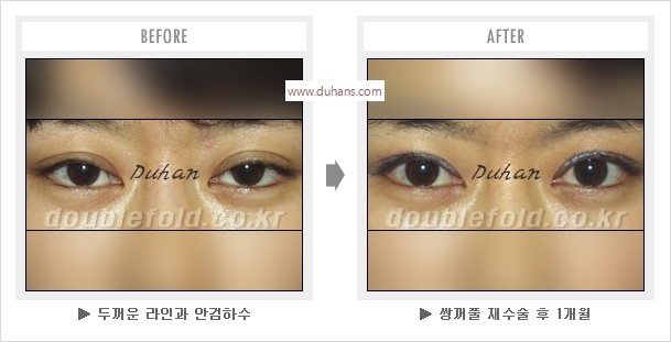 [두한성형외과 경쟁력 눈성형] - [나에게 맞는 어울리는 쌍꺼풀 라인] 관련 이미지 23