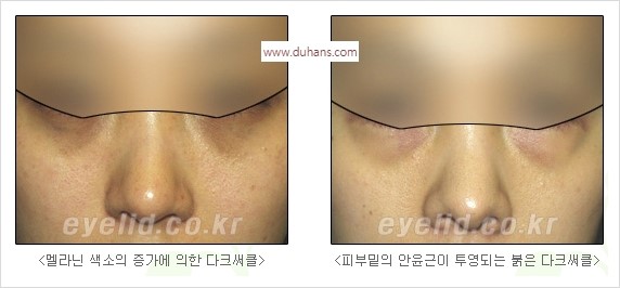 [두한성형외과 경쟁력 눈밑성형] - [눈밑 다크써클 수술 방법] 관련 이미지 2