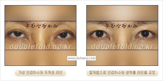 [두한성형외과 경쟁력 쌍꺼풀 재수술, 극한 눈재수술] - [안검하수 검사 및 수술방법 안내] 관련 이미지 18