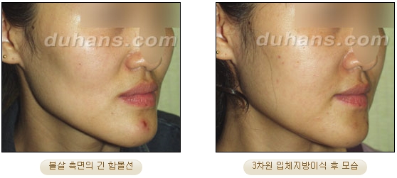 [두한성형외과 얼굴자가지방이식] - [볼살, 이마, 측두부] 관련 이미지 26