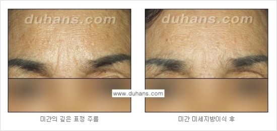 [두한성형외과 경쟁력 주름성형] - [세월의 흔적! 주름을 교정하는 여러 가지 교정 방법] 관련 이미지 17