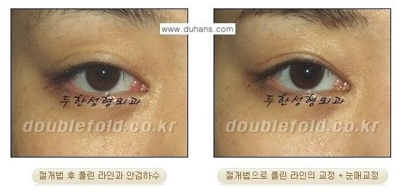 [두한성형외과 경쟁력 쌍꺼풀 재수술, 극한 눈재수술] - [풀린 쌍꺼풀 라인 교정수술 안내] 관련 이미지 2