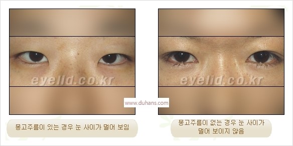 [두한성형외과 경쟁력 눈성형] - [흉터없는 몽고주름 제거술(앞트임) 관련 이미지 1