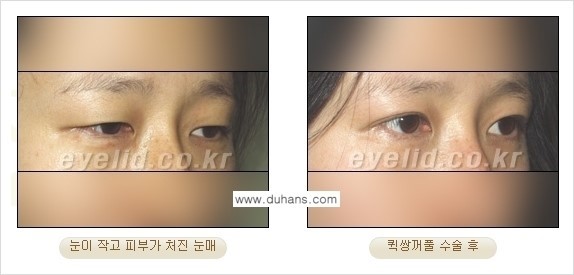 ​[두한성형외과 경쟁력 눈성형] - [자연스러운면서 매력적인 쌍꺼풀 퀵 쌍꺼풀 수술 안내] 관련 이미지 27